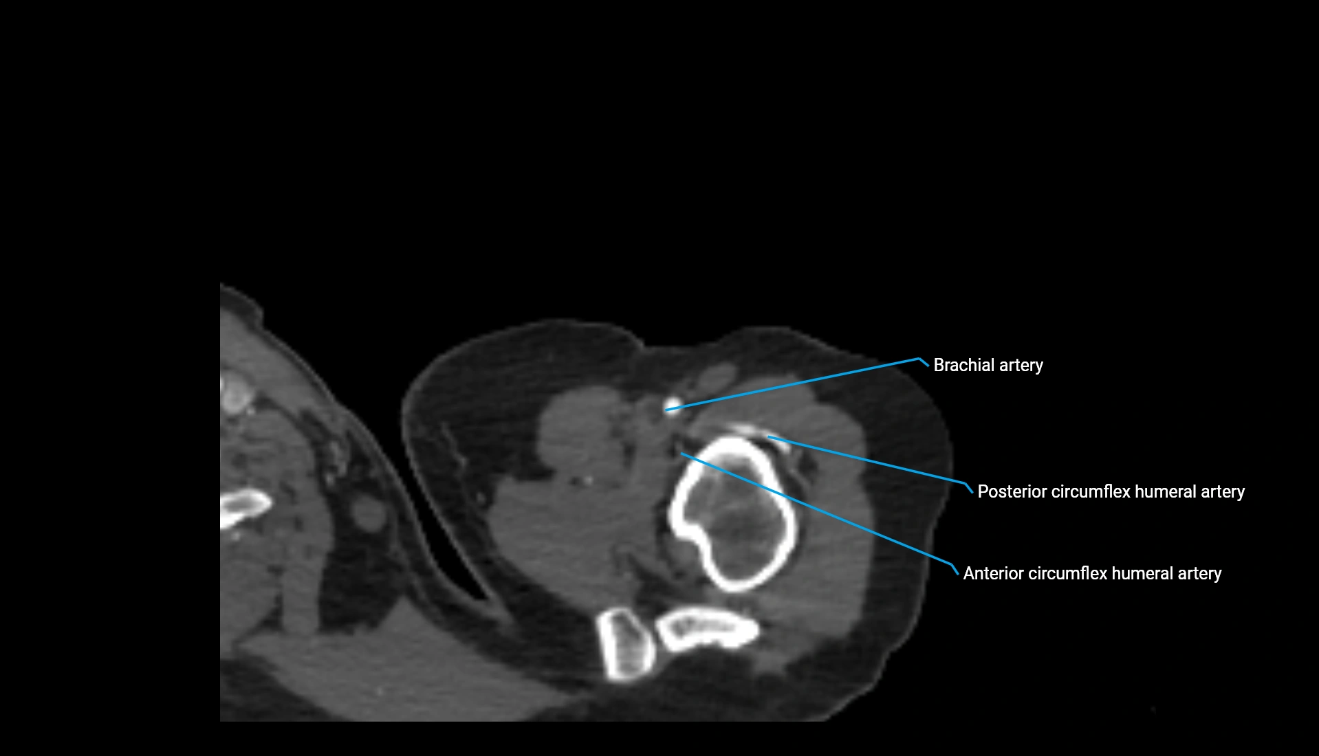 CTA upper limb axial cross sectional anatomy labelled image 316 (1).webp